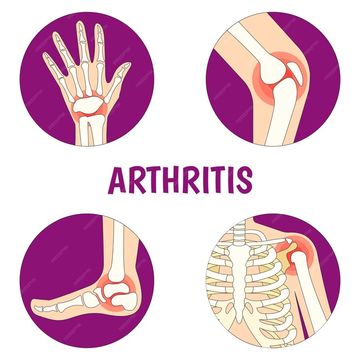 Arthritis