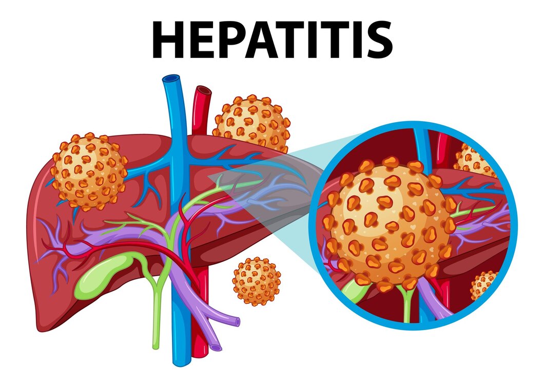 Hepatitis