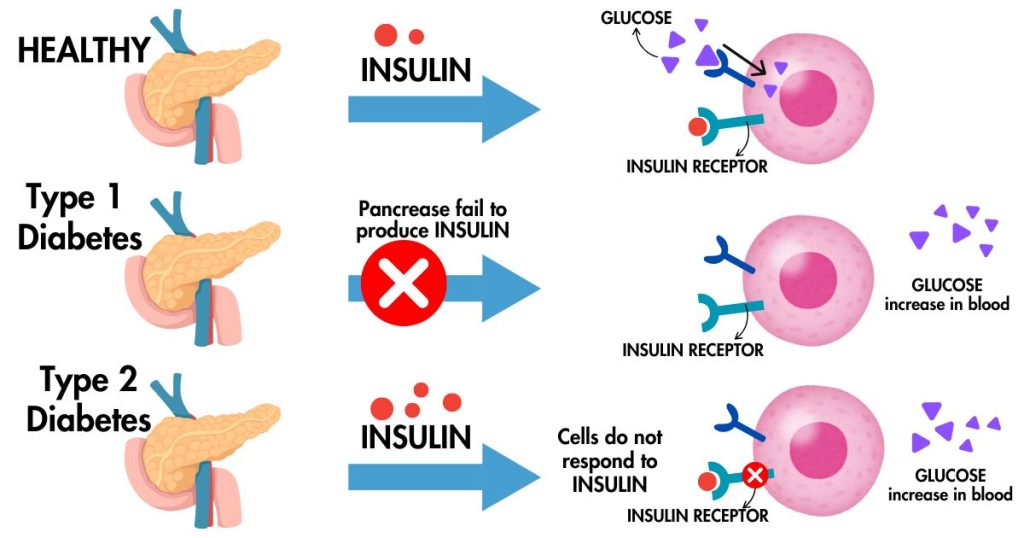 Diabetes: What It Is, Causes, Symptoms & Types -HealingClap 2 What-is-diabetes-causes-symptoms-types-2